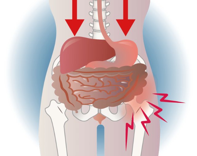 Illustration of the abdomen and pelvis: sagging organs with red arrows pressing down, pain marked at the hip