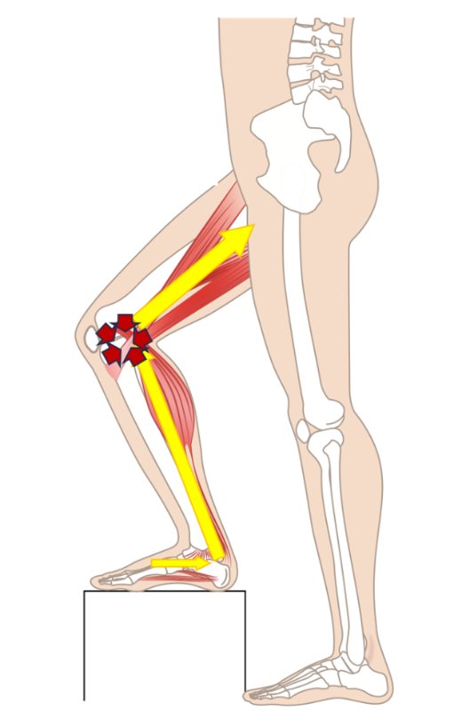 Side view of the leg with the knee bent on a step: contracted calf and thigh muscles pull on the knee joint